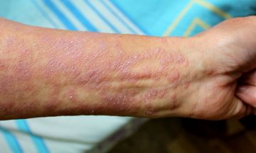 Lichen planus causes - Do not allow it to grow on you.