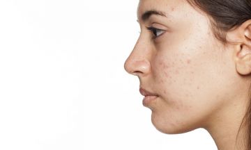 Can hormonal changes cause acne?