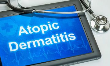 Treat atopic dermatitis naturally with homeopathy