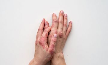 PSORIASIS: CAN IT BE TREATED?