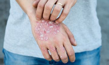 Can psoriasis skin disease go away?