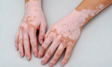 Can vitiligo turn you completely white?