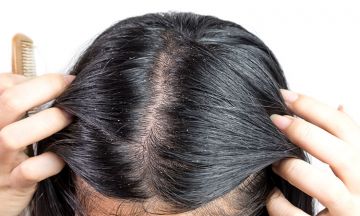 Do you want to leave your hair fall behind in this race? Switch to Homeopathy.