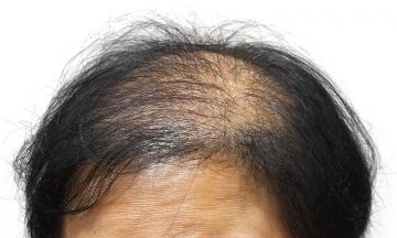 Is your hair loss just due to stress or there is some underlying disease causing it?