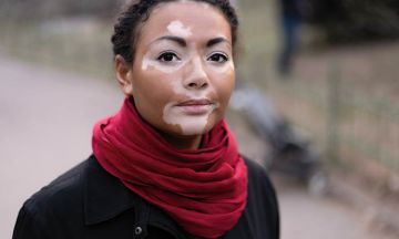Vitiligo: Homeopathic help for a disfiguring skin disorder 