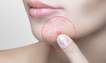 Want to get rid of that ever-present acne? Here’s why you should consider Homeopathy.
