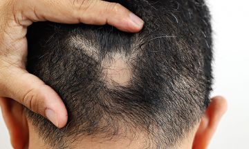 Can alopecia be cured with homeopathy? 