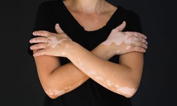 Role of Geno Homeopathy in diagnosing Vitiligo