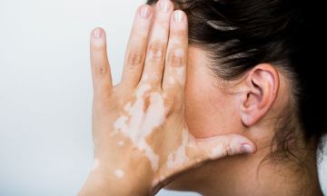 Is vitiligo permanent? How to treat it?