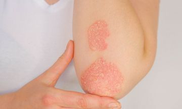 Will you get psoriasis from your genes? Diagnose with Geno Homeopathy