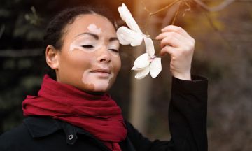 How to reclaim confidence of your loved ones who've been diagnosed with vitiligo?