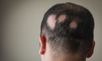 Is alopecia caused by stress? 