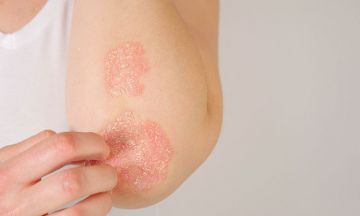 Things you're tired of hearing about Psoriasis