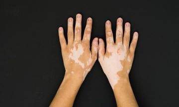 Causes and treatment options of vitiligo