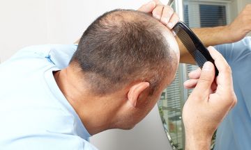 Difference between normal hair loss and advancing male pattern baldness