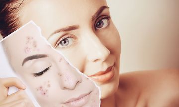 Don’t Let Acne Scar Your Confidence - Acne Vulgaris Treatment With Homeopathy