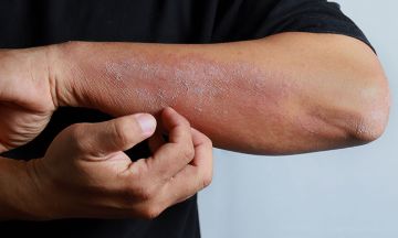 Eczema myths busted