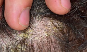 Know how homeopathy treats scalp psoriasis