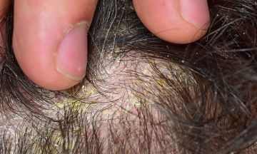 Tinea Capitis Symptoms Causes  Treatment