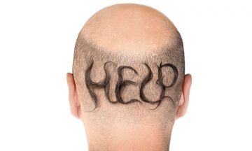 Receding Hairline? Find Alopecia Treatment in Homeopathy!