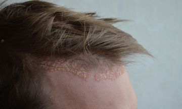 Self-care tips to manage scalp psoriasis