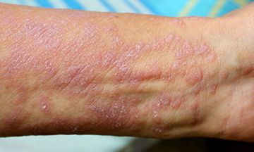Freedom from leisons of Lichen Planus with Homeopathy