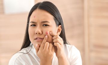 Get Rid Of Acne With Homeopathy Treatment