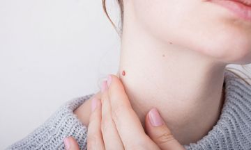 papilloma medicine in homeopathy