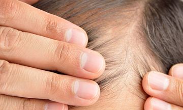 How can Homoeopathy help me with my thinning hair?