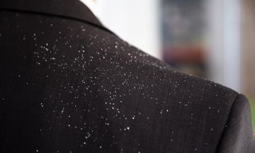 GET RID OF SEBORRHOEIC DERMATITIS WITH HOMEOPATHY!