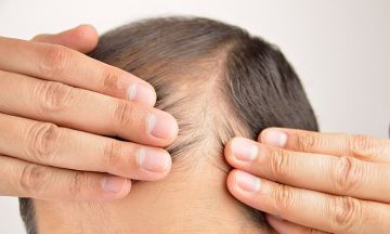 How can Homoeopathy help me with my thinning hair?