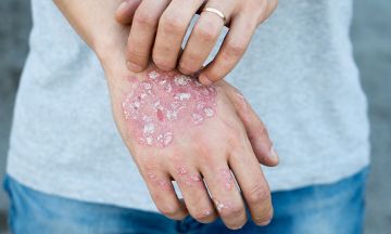 Combination of treatment plans for severe psoriasis