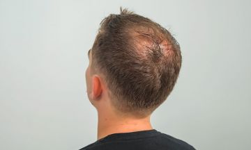 Male pattern baldness troubling you? Treat it with homeopathy