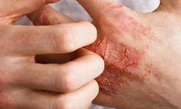 Read here to know how homeopathy treats eczema efficiently
