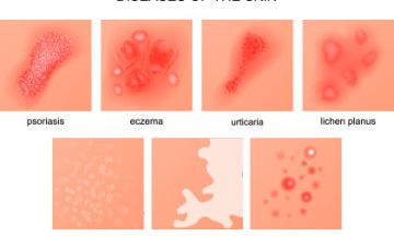 Red, itchy, flaky skin? It might be due to acne, eczema or psoriasis. And you might be anxious or depressed about your skin condition. But don’t worry. This blog enlightens you with the most common skin conditions and how homeopathy treats holistically. • Acne Most teenagers have acne and it can cause great emotional distress at an age when many are very self-conscious. It is caused by the overproduction of natural grease called sebum, which is secreted by glands in the skin. • Eczema Also known as dermati
