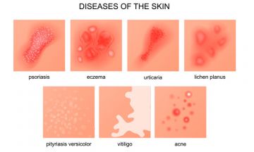 Red, itchy, flaky skin? It might be due to acne, eczema or psoriasis. And you might be anxious or depressed about your skin condition. But don’t worry. This blog enlightens you with the most common skin conditions and how homeopathy treats holistically. •	Acne Most teenagers have acne and it can cause great emotional distress at an age when many are very self-conscious. It is caused by the overproduction of natural grease called sebum, which is secreted by glands in the skin.  •	Eczema Also known as dermati