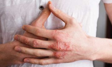 Fight eczema with homeopathy