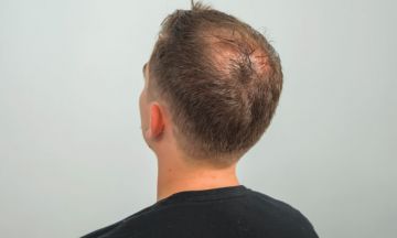 Know these stages of male pattern baldness