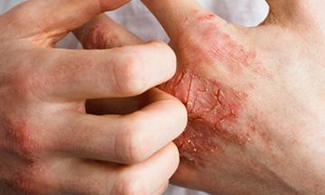 Skin disorders annoying you? Try homeopathy