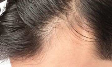 Homeopathy - Safest treatment for your hair