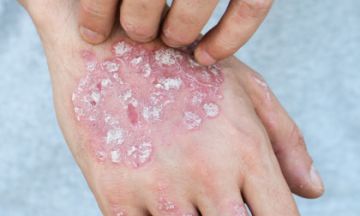 Skincare mistakes to avoid if you've Psoriasis