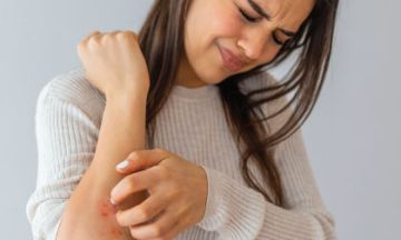 Itching to deal with psoriasis? Try homeopathy