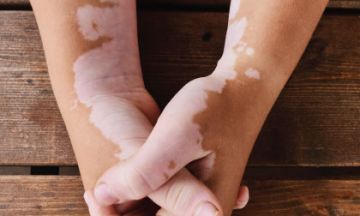 Homeopathy: Natural and holistic approach for Vitiligo