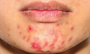 Acne can be painful too! Try homeopathy