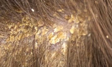 Seborrheic Dermatitis? Treat it with Homeopathy!