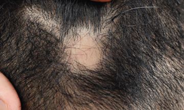 HOW TO LIVE WITH ALOPECIA AREATA?