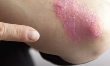 Psoriasis is more than just dry skin!