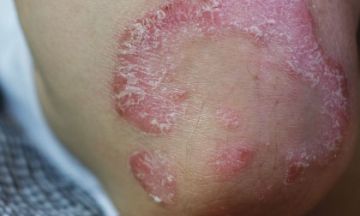 Don't deal with psoriasis. Seek homeopathy treatment!