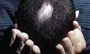 Why Homeopathy is the best treatment for Alopecia Areata?