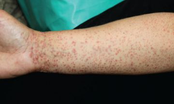 Lichen Planus Symptoms Causes Treatment Bulksupplements Com